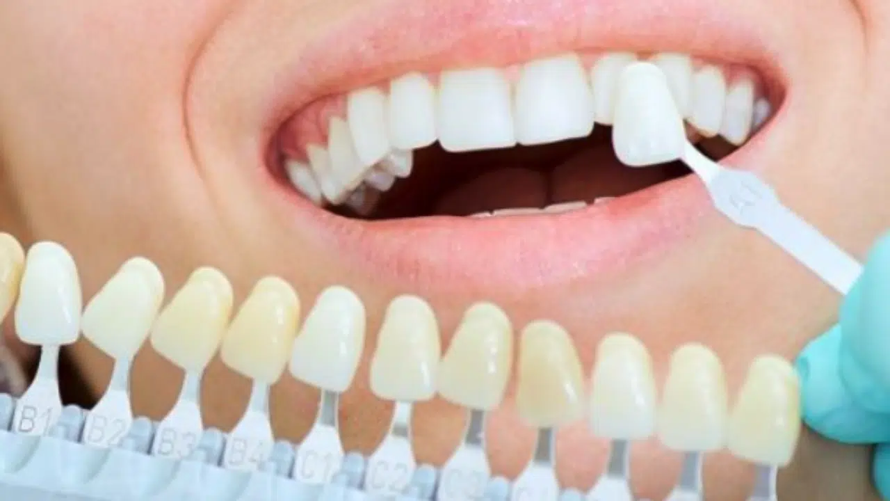 How Long Does Composite Bonding Take