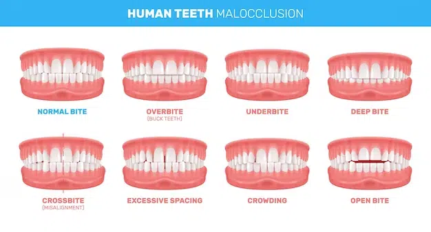 Mechanism of Gradual Teeth Movement
