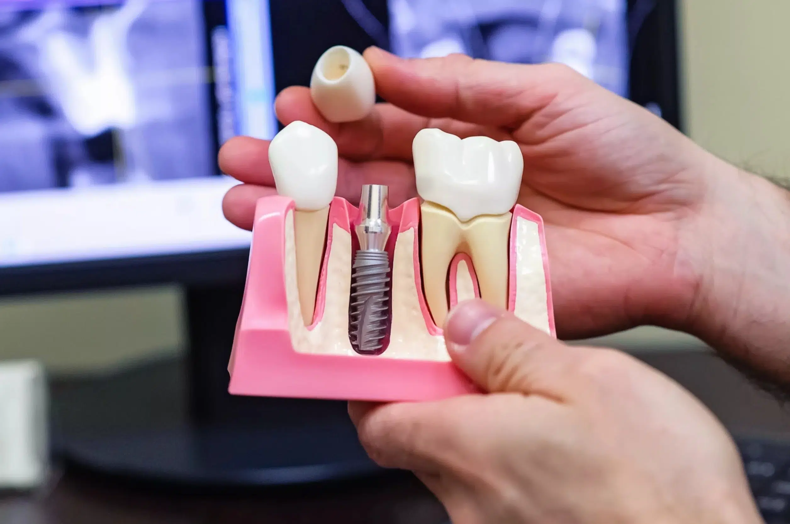 Procedure of Dental Implants