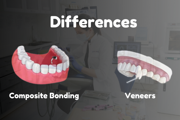 Composite Bonding vs Veneers