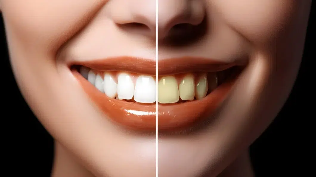 Benefits of Composite Bonding
