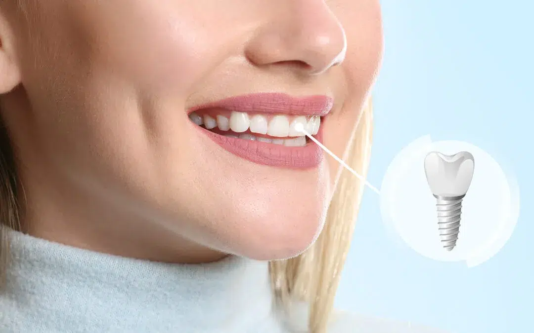 Long-Term Relieve Pain from Dental Implants