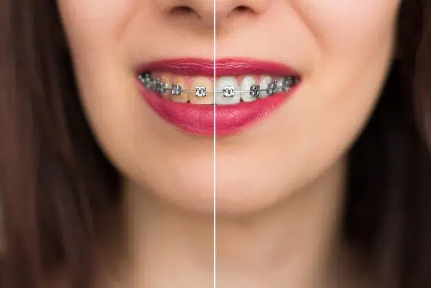 Braces vs. Composite Bonding