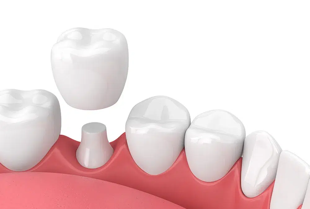 Dental Crown