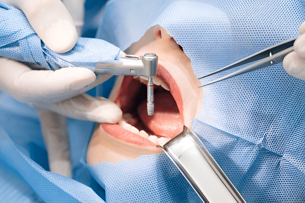 same day dental implants