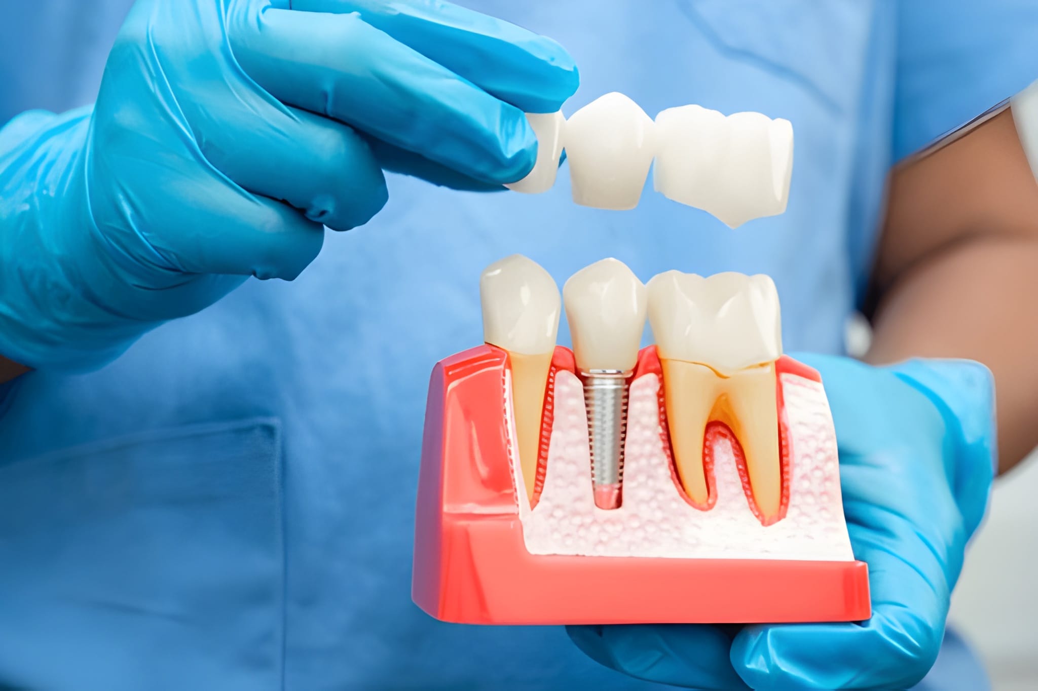 how long do dental implants last