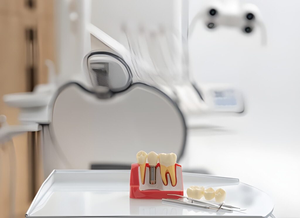 dental implant lifespan