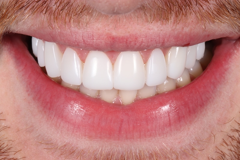 After treatment