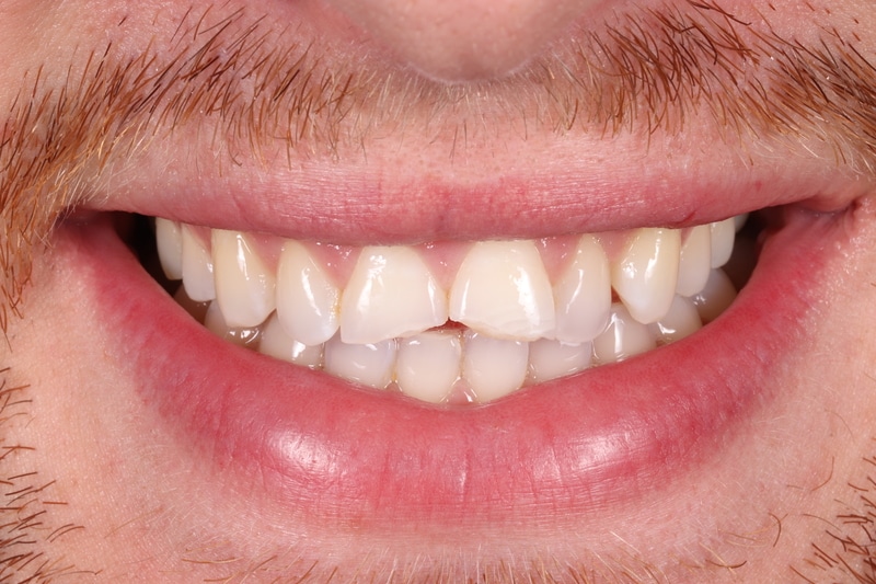 Before treatment